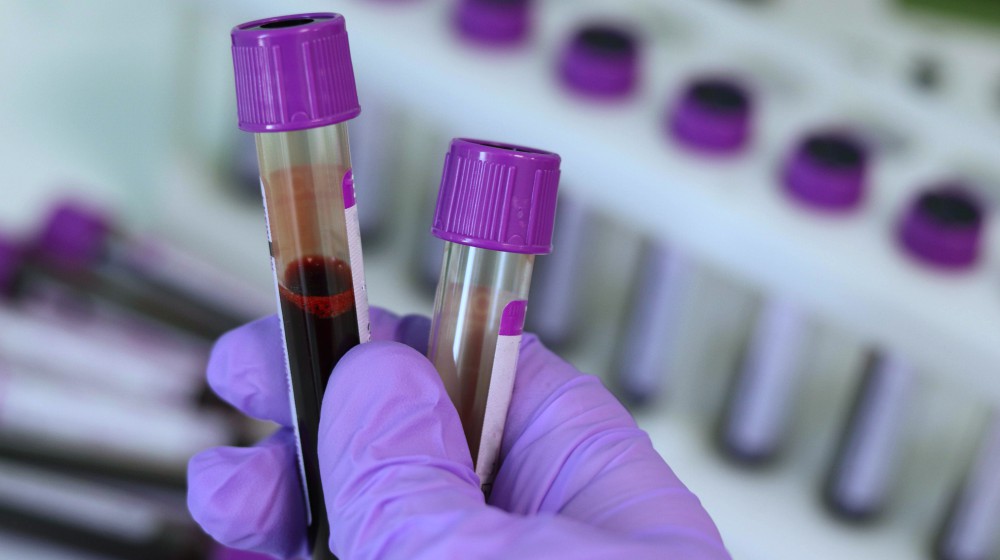 person holding blood samples | How Lack Of Sleep Affects Metabolism And Causes Weight Gain | sleep and metabolism | lack of sleep weight gain 