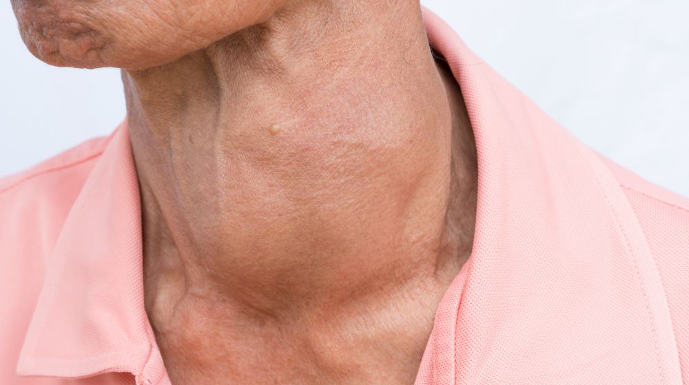 close up shot of person with thyroid problem | Symptoms Of Thyroid Cancer To Watch Out For | symptoms of thyroid cancer | thyroid cancer treatment